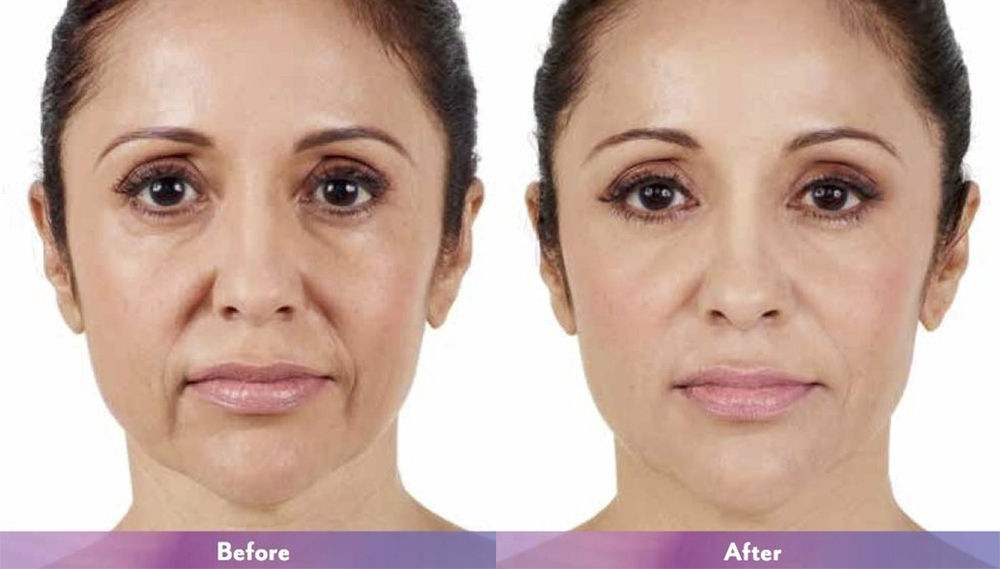 Juvederm Before & After 3