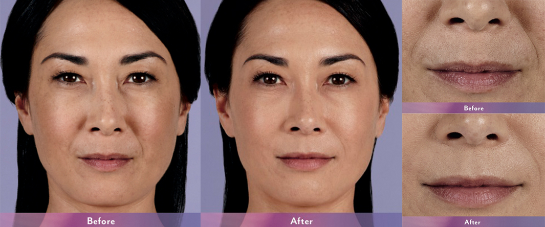 Juvederm Before & After 4