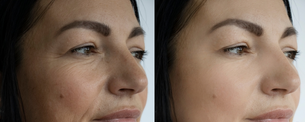 Wrinkle Reduction in Redlands, CA | Ingrid E. Trenkle, MD